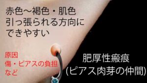 ピアスホールの肉芽(肥厚性瘢痕)