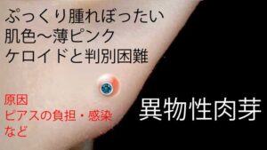 ケロイドの治療